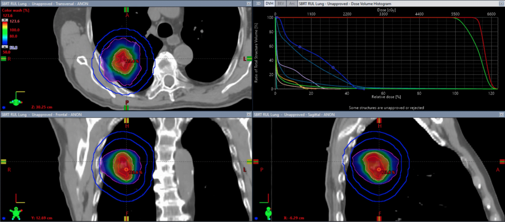 SBRT Eclipse Lung RUL Planning - MDS School